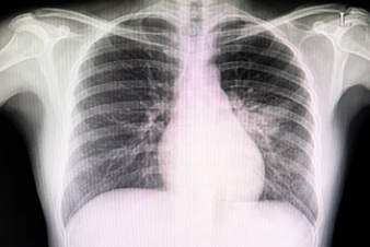 derrame pleural